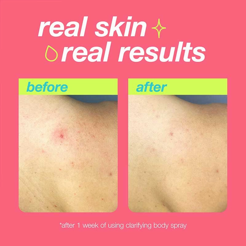 Dermalogica Clear Start Clarifying Body Spray Discontinued